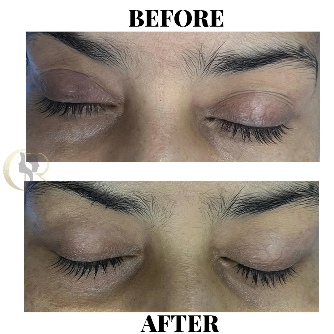 Anti-aging treatment result showing Robotic Face Lift (Ultraformer MPT) on Day 10 along with Beauty Drip IV Infusion Therapy at Cosmo Radiance Hyderabad India Anti-aging treatment result showing Robotic Face Lift (Ultraformer MPT) on Day 10 along with Beauty Drip IV Infusion Therapy at Cosmo Radiance Hyderabad India